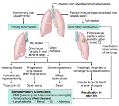 Extrapulmonary Tuberculosis
- CNS: parenchymal tuberculoma or meningitis
- Vertebral body: Pott disease
- Lymphadenitis
- Renal
- GI
- Adrenals