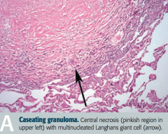 - Central necrosis (pinkish region in upper left)
- Multinucleated Langhans giant cell (arrow)