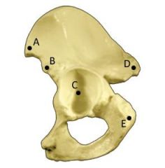 In order to determine the boundaries of the posterior-superior safe zone for acetabular screw placement during THA, a line is initially drawn through which of the following two anatomic landmarks, represented by dots on the illustration? 1-A and C...