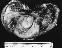 302. The answer is f.
The tumor in question 302 is an opened mature cystic teratoma (dermoid tumor) in which hair is visible.