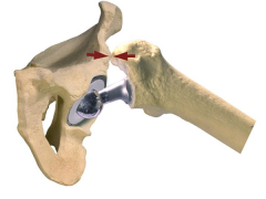 Hx:67yo F underwent a THA 6 months ago and has had recurrent prosthetic dislocations. Fig A is a  drawing of the mechanism of her dislocation. During the time of surgery what is the most likely factor leading to the bone-on-bone impingement?  1-La...