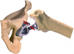 decreased hip offset places the hip at risk for the femoral bone impinging against the pelvis at the extremes of motion. 

There are several ways the femoral offset can be decreased leading to bone-bone impingment. One such way is medializing an...