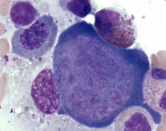 Aplastic Crisis
- Infects erythroblasts in the BM
- They will require a blood transfusion to live