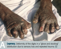 - Skin 
- Superficial nerves: "glove and stocking" loss of sensation

- Armadillos (reservoir)