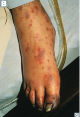 - Meningococcemia (picture)
- Meningitis
- Waterhouse-Friderichsen syndrome

Prevent: Rifampin, Ciprofloxacin, or Ceftriaxone prophylaxis in close contacts

(Ceftriaxone or Penicillin G can be used for treatment)