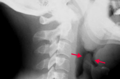 Which bacteria causes an infection that leads to the "thumbprint sign" on lateral neck radiograph?