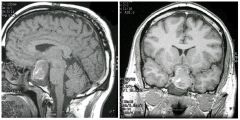 PT P/W "WORST HA EVER!", WEAKNESS IN HIS RIGHT ARM AND LEG AND PERIPHERAL BLINDNESS. MENINGEAL SIGNS ARE NOTED AS WELL AS HOTN. DX? WHAT INDICATES EMERGENT SX? TEST OF CHOICE?