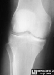 PT P/W KNEE PAIN. XR SHOWS INTRARTICULAR LINEAR CALCIFICATIONS. DX?