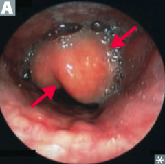 HaEMOPhilus causes
- Epiglottitis ("cherry red" in children)
- Meningitis
- Ototis media
- Pneumonia