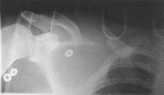 A 30-year-old male sustains a right shoulder injury with initial radiographs shown in Figures A and B. What single piece of additional information would best assist in determining this patient's functional outcome?  
1.  Lower extremity injury 
...