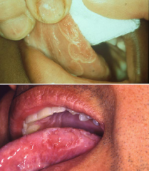 Traumatic and Inflammatory:
Geographic Tongue