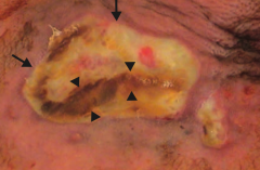 Ecthyma gangrenosum
- Rapidly progressive
- Large ulcer (arrows)
- Necrotic cutaneous lesions (arrowheads)