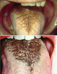 Traumatic and Inflammatory:
Hairy tongue
