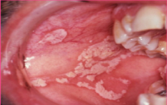 Infections:
Candidiasis.