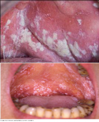 Infections: 

Acute Pseudomembranous Candidiasis