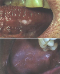Infections: 

Chronic Hyperplastic Candidiasis