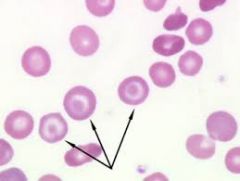 Given the blood smear, what type of anemia is most likely?

 