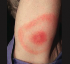 - Erythema chronicum migrans - expanding bulls eye red rash (picture)
- Flu-like symptoms
- +/- Nerve palsy