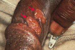 Localized disease, presents with PAINLESS chancre
