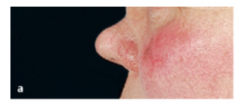 -  Zerstörung der Nasenknorpelsubstanz mit Septumperforation und Ausbildung einer Sattelnase