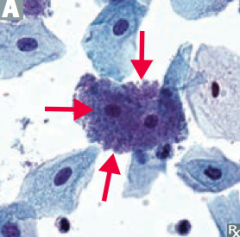 - Pleomorphic
- Gram-variable rod
- Involved in vaginosis
- CLUE cells or vaginal epithelial cells covered with Gardnerella bacteria are visible under the microscope (arrow)
