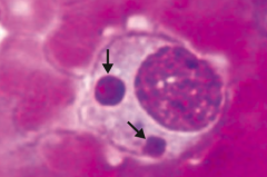 Which disease is pictured: monocytes with morulae (berry-like inclusions) in cytoplasm?