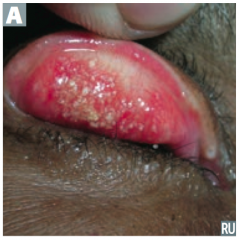 Mucosal infections
- C. trachomatis causes reactive arthritis (Reiter syndrome), follicular conjunctivitis (picture), non-gonococcal urethritis, and PID
- C. pneumoniae and C. psittaci cause atypical pneumonia (aerosol transmission)
