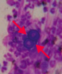 Blastomycosis
- Causes inflammatory lung disease and can disseminate to skin and bone
- Forms granulomatous nodules
- Blasto Buds Broadly (same size as RBCs)