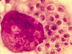 Histoplasmosis
- Causes pneumonia
- Macrophages filled with histoplasma (smaller than RBCs) - "Histo Hides (within macrophages)"
- Associated with bird and bat droppings