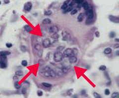 Coccidioidomycosis 
- Causes pneumonia and meningitis
- Can disseminate to skin ("desert bumps" = erythema nodosum) and bone ("desert rheumatism" = arthrlagias)
- Case rate increases after earthquakes (spores in dust are thrown up in the air an...