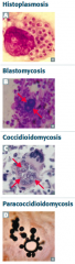 - Histoplasmosis: smaller than RBC
- Blastomycosis: same size as RBC
- Coccidioidomycosis: much larger than RBC
- Paracoccidioidomycosis: much larger than RBC