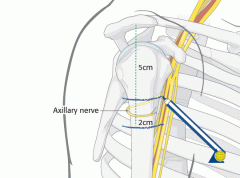 No more than 5cm below the acromion in order to avoid injury to the axillary nerve as it exits from the quadrangular space. If dissection is carried below here deneravation of the anterior portion of the deltoid could occur