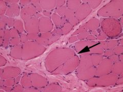 Dystrophic changes
Muscle fiber size variability
Endomysial fibrosis 
Increased central nuclei (> 3% of muscle fibers) 
Segmental necrosis of muscle fibers, often with myophagocytosis 
Regeneration 
Ring fibers 
Fatty infiltration and repla...