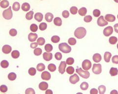 Acquired (auto-immune hemolytic anemia) and Inherited (hereditary spherocytosis)