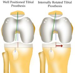 The posterior condylar axis may be used to determine the rotation of the femoral component in TKA. Which of the following describes the nl relation of the posterior condylar axis:  1-Parallel to the transepicondylar axis; 2-Perpendicular to the an...