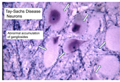 Abnormal accumulation of gangliosides