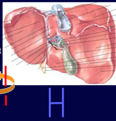 Lobes: R, L, quadrate (inf), caudate (sup)
Surfaces: Diaphragmatic and visceral
H shape:
- ligamentum venosum (remnant of Ductus venosus)
- Ligamentum teres hepatis (aka round lig of L, remnant of umbilical v)
- IVC
- gallbladder
- Porta hepatis ...