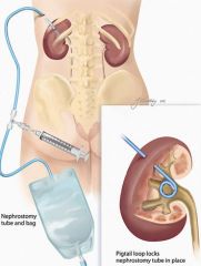 1. Treatment depends on duration, severity, location and cause of the obstruction
2. location of the obstruction
a. lower urinary tract obstruction- urethral catheter for acute obstruction. Dilatation or internal urethrotomy - if cause is urethr...