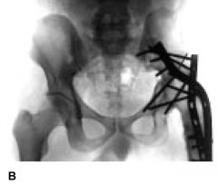 Hx:18yo M w/severe hip OA and pain from a missed SCFE. You decide that a hip arthrodesis is the best treatment option. What is the optimum position for a hip arthrodesis to maximize function and prevent complications? 1-0° ER, 0° add, 0° hip fl...