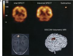 1. Ictal SPECT can measure increase in blood flow at the site of epilepsy focus
2. Subtraction ictal SPECT coregistered MR (SISCOM) takes the ictal image and subtracts it from the interictal image, and the difference is coregistered to MRI to loca...