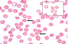 PB smear shows bite cells