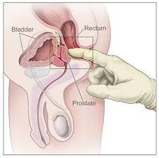 1. carcinoma is characteristically hard, nodular and irregular
2. normal prostate feels like a thenar eminence (group of muscles in the palm of the hand at the base of the thumb), while prostate cancer feels like knuckle. Men with induration, asy...