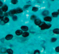 Yeast:
- Disc-shaped yeast forms on methenamine silver stain of lung tissue