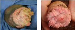 - the peak incidence of this tumor is in men in their 7th decade
- circumcision may have protective effect because penile cancer is very rare in those who have been circumcised
- It is associated with HSV and HPV 18 infections
- It presents as ...