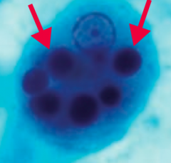 Entamoeba histolytica (GI protozoa)
- Transmitted via cysts in water
- Diagnosed w/ serology and/or trophozoites with RBCs in the cytoplasm (picture) or cysts (with up to 4 nuclei) in the stool
- Treat with Metronidazole; iodoquinol for asympto...