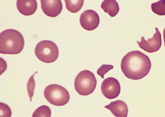 - Thrombotic Thrombocytopenic Purpura (TTP)
- Malignant HTN
- Anti-phospholipid Ab Syndrome
- Disseminated Intravascular Coagulation (DIC)
- Disseminated cancer