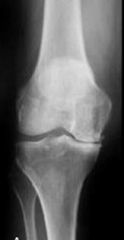 Hx:67yo F sustained an ACL tear while playing basketball when she was 35yo. She has noted progressive leg deformity and episodes of giving way, and now has pain preventing activity. Non-op has failed to provide relief. Treatment should consist of?...