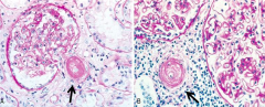 Hyaline Atherosclerosis - shears RBCs d/t thickening