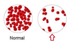 Abnormal low of RBCs or hemoglobins in the blood. Blood oxygen-carrying capacity is too low to support normal metabolism.