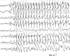 Du tar EEG av en pasient med mulig epilepsi, og får dette resultatet. Hvilke symptomer tror du denne pasienten har?
